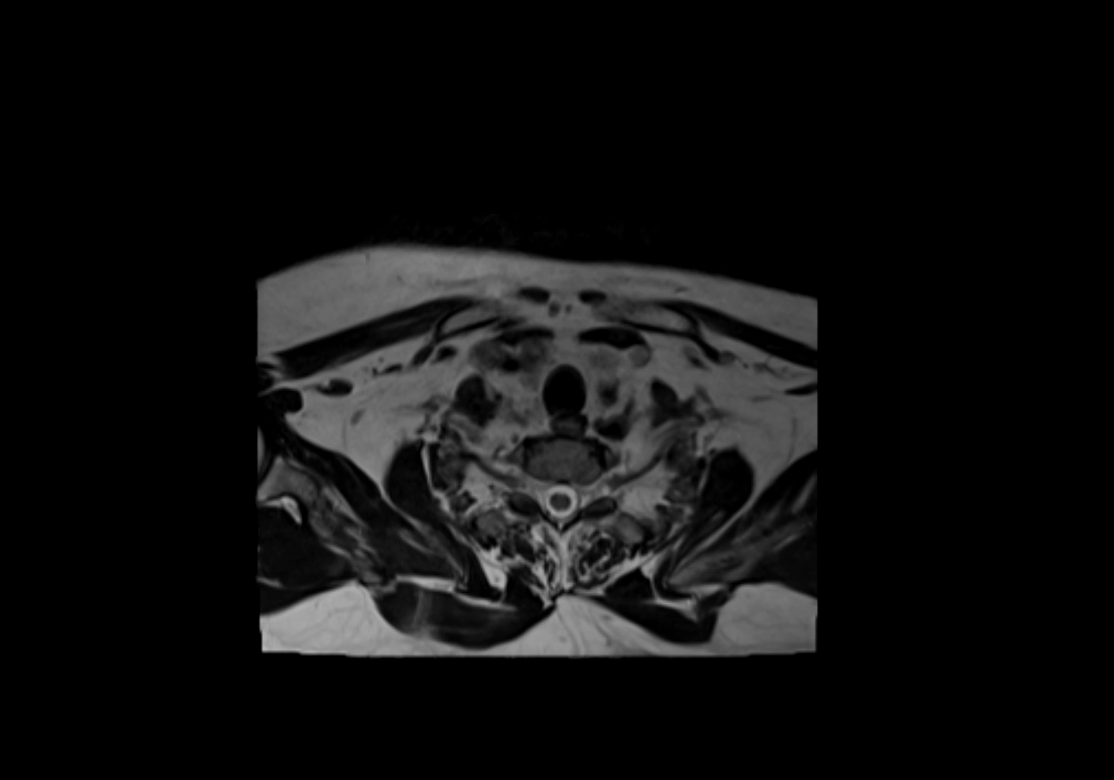 Neck axial  lymph node cross sectional MRI anatomy 3T MRI  image-img-00001-00091.webp